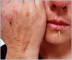 Image result for Erythema Multiforme Major