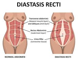 Abdominal anatomy of pregnant woman. How To Tell If You Have Torn Abs During Pregnancy Diastasis Recti