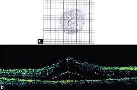 Resurrection Of The Amsler Chart In Macular Diseases Nassar