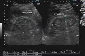 Chronic renal failure usually happens slowly overtime from a known or unknown chronic renal failure develops into end stage renal disease (esrd). Chronic Renal Failure Chronic Renal Failure Renal Failure Renal