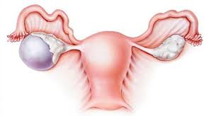 Rahim içi yapışıklık ultrasonda görülür mü, tedavisi nasıl yapılır? Rahim Kanseri