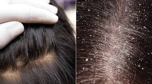 Does anyone have any experience with this? Head Lice Vs Dandruff Identifying What You Have