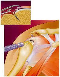 Les tendons sont les tissus fibreux qui relient les muscles aux os. Chirurgie De La Rupture Des Tendons De L Epaule Dr Givry A Dijon