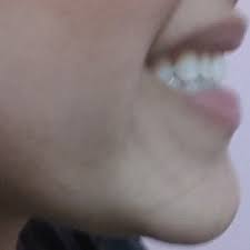 Анджелина джоли | angelina jolie. Can I Get Angelina Jolie Smile With Veneers Can I Get Grafts