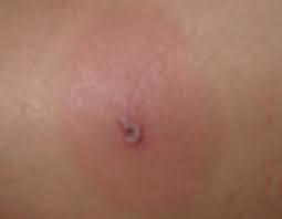 Which spider bites can be fatal? Pin On Spider Bites