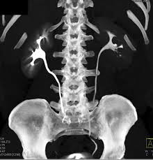 Image result for Acute Pyelonephritis