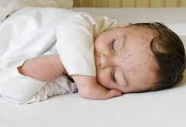 Roseola is also termed sixth disease, roseola infantum, and exanthema subitum. Viral Rash In Infants Types Diagnosis Treatment