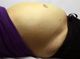 Abdominal pain can be a symptom of ovarian cancer. Malignant Ascites Diagnosis And Management Cancer Therapy Advisor