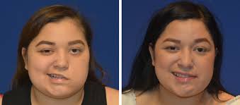 Viruses that have been linked to bell's palsy include viruses that cause: Bell S Palsy Facial Paralysis Treatment Los Angeles California
