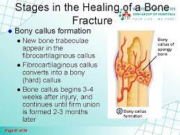 Fractures And Bone Healing Page 1 Of 39