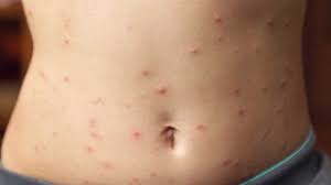 Itching skin bumps may be the result of a number of things, including allergies, insect bites, or skin conditions like eczema. Raised Skin Bumps Pictures Types Causes And Treatment