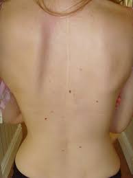 Lauren Loves Fashion Beauty And Lifestyle Blog Spinal Fusion Surgery Spinal Fusion Scoliosis Surgery
