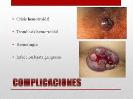 El color que queda en la zona del ano por una trombosis. Enfermedades Anorrectales Anatoma Limites Recto Y Ano Recto