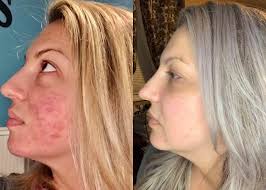 Has anyone tried Liv Schmidt's Skinni Societe? Any lasting success with it? 