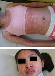 Image result for Erythema Multiforme Major