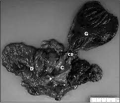 The Ampullar Of Vater Showing Normal Feature Grossly And Slight Download Scientific Diagram