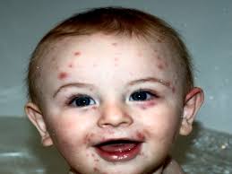 È molto meno frequente in bambini di età inferiore ai 2 anni. Scarlattina Cos E Come Si Manifesta E Come Curarla Assocarenews It Quotidiano Sanitario Nazionale