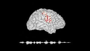 Brain Implant Device Allows People With Speech Impairments