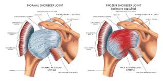 Image result for Frozen Shoulder