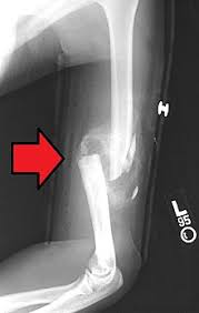 Functional bracing for the treatment for later. Sarmiento Brace Wikipedia