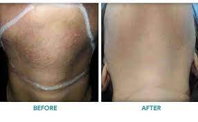 Costs of laser hair removal. Best Laser Hair Removal In Jaipur Dr Vishal Chugh