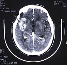 Early Symptoms Of A Brain Tumor Ehow Brain Tumor Brain Tumor Awareness Brain Tumor Symptoms