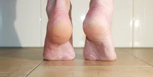 Doch nicht nur aus ästhetischen gründen sollten sie beim schneiden und feilen der nägel sowie hobeln der hornhaut behutsam. Alles Uber Hornhaut