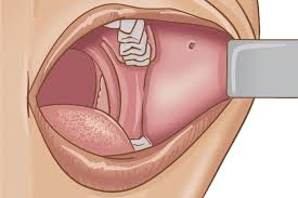 Blood blister inside cheek from biting on a hard piece of fried chicken. Buccal Cancer Thanc Guide