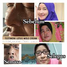 Lantas banyak yang ingin tahu cara menghilangkan tahi lalat untuk mengatasi. Krim Buang Tahi Lalat Ø§Ù„ØµÙØ­Ø© Ø§Ù„Ø±Ø¦ÙŠØ³ÙŠØ© ÙÙŠØ³Ø¨ÙˆÙƒ