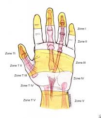 Flexor Tendon Zones Of Hand Bone And Spine Hand Therapy Hand Surgery Hand Injuries