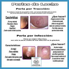 Amplificador Entonces Donacion Punto Blanco En El Pezon Y Dolor Globalbridgegroups Com
