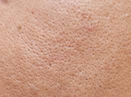 Why Your Pores Are So Big How To Unclog Them In 2020 Skin Care Secrets Skin Care Acne Skin Care Tips