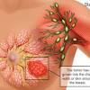 Read all information of breast cancer symptoms, treatments, causes, tests breast cancer is the uncontrolled malignant growth of cells in the breast tissue. 1