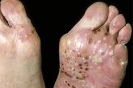 Image result for Pustular Psoriasis