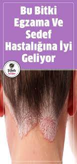 Bu Bitki Egzama Ve Sedef Hastaligina Iyi Geliyor Nemli Her Ortamda Yeti Bitki Bu Egzama Geliyor Hastaligina Iyi Nemli Dogal Saglik Bitki Saglik