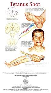 We did not find results for: What Does A Tetanus Wound Look Like Would The Wound Be Infected With Pus And Redness Or Not Quora