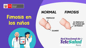 Fimosis En Los Ninos Youtube