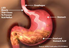 Acidity and GERD