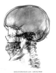We did not find results for: X Ray Head Schedel Lat White Stock Photo Edit Now 1457517809 Stock Photos Photo Editing X Ray
