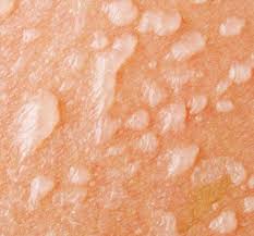 Pour les enfants, les érythèmes apparaissent sur leur corps. Comment Se Debarrasser De Coup De Soleil Ampoules