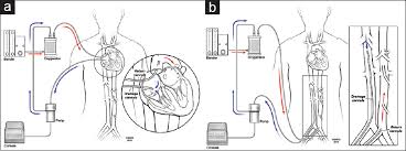 Cannulation Strategies In Adult Veno Arterial And Veno