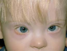This is often associated with a broad flat nasal bridge. Down Syndrome Trisomy 21 American Academy Of Ophthalmology