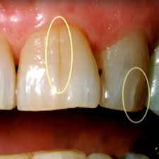 Therefore taking a garlic clove on an empty stomach in the morning is one of the best home remedies to get rid of tooth decay and cavities. How To Fix Rotting Teeth At Home Teethwalls