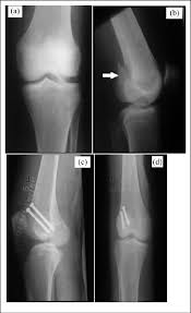 Image result for Lateral Condyle Fracture