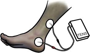 Position Of Electrodes For Transcutaneous Posterior Tibial