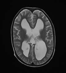 Vp Shunt Migration Radiology Case Radiopaedia Org