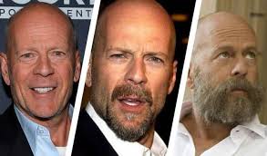 Been on finasteride for just over 2 years. Here S Why Every Balding Man Needs To Grow A Beard Now