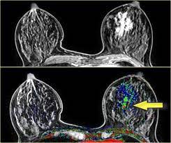 Most cases are invasive ductal carcinomas, which develop in the cells lining the milk ducts and spread throughout the breast. The Radiology Assistant Mri Of The Breast