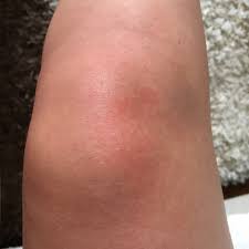 Schmerzen Und Schwellung Bei Aktivitat Am Knie