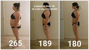 Last 2 days feeling like upset stomach with pain after eating not drinking. Gastric Sleeve Vsg 8 Months Post Op Skin Flick Before And After Pics Youtube